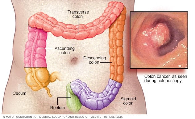 How to Maintain and Keep your Colon Healthy